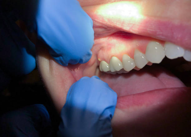 Best Emergency Broken Tooth Repair in Tiger Point, FL